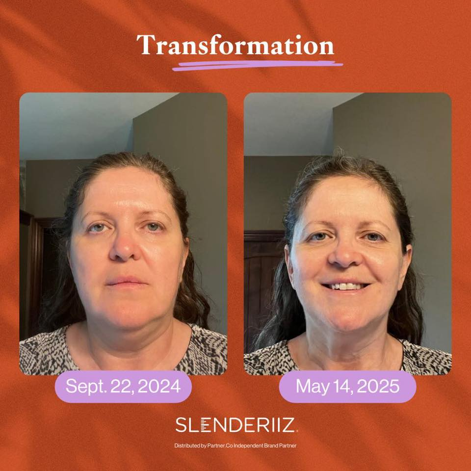 Paula Allen's before and after photos show reduced inflammation in her face thanks to the Skinny Drops