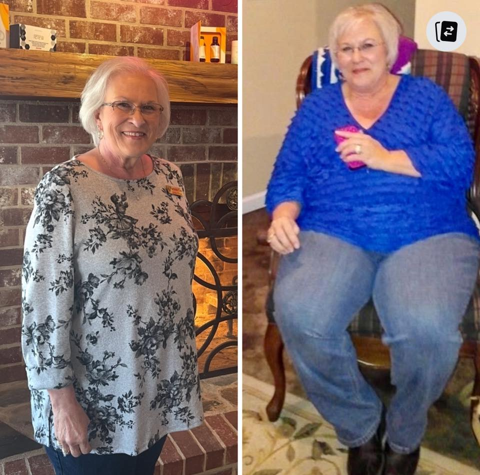 Linda Davis Sitzer's before and after photos show 110 pounds released in her weight loss journey with the Skinny Drops