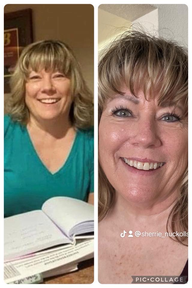 Sherrie Nuckolls' before and after photos show reduced inflammation in her face, thanks to the Skinny Drops