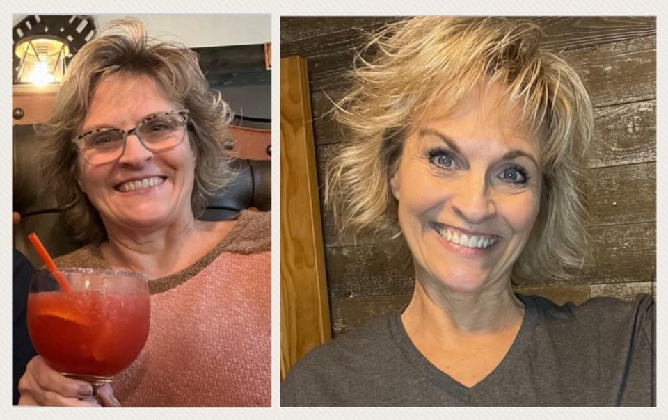 Carma Luetkenhaus' before and after photos show reduced inflammation in her face, thanks to the Skinny Drops