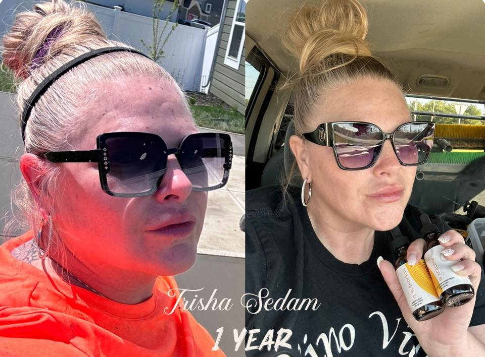 Trisha Sedam's before and after photos show reduced inflammation in her face, thanks to the Skinny Drops